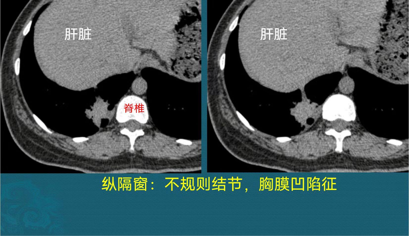 辟谣得了癌不治能活得更久,癌症能不能治医生说了大实话