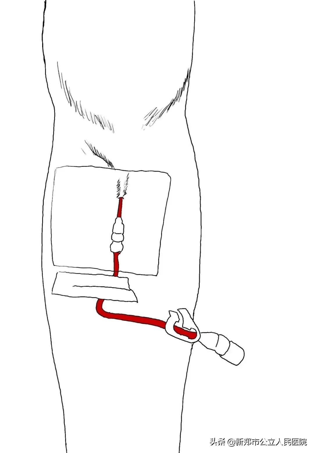冠脉造影科普宣讲,冠脉CT血管造影