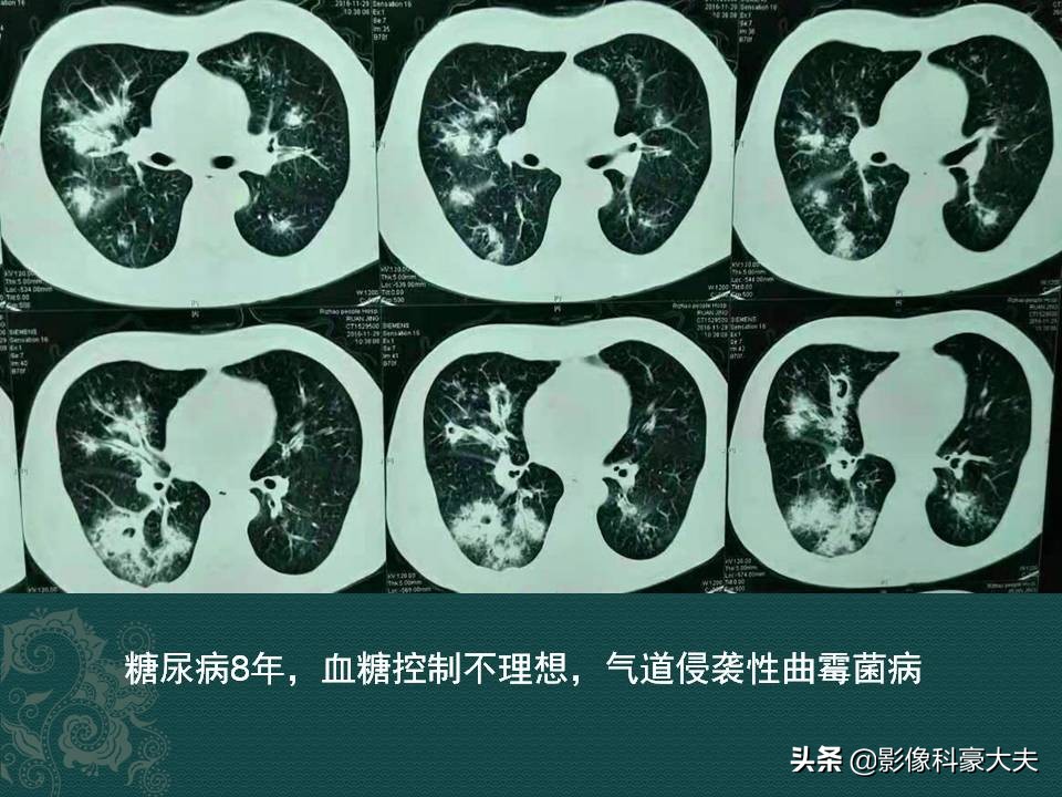 32岁宝妈发烧咳血肺空洞,糖尿病不吃药,风险有多大?