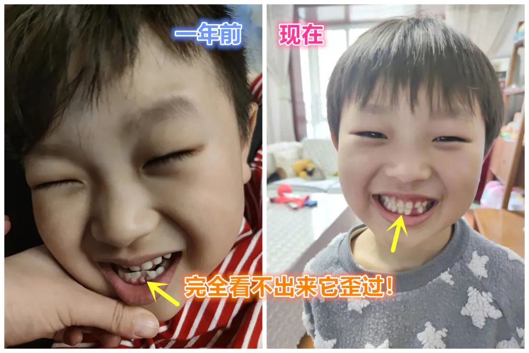为什么乳牙好换牙就不好了,为什么现在的孩子换的门牙特别大