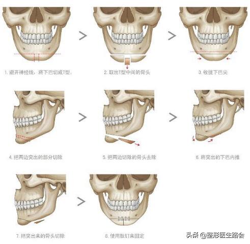 面中部凹陷下巴微翘,朱元璋式下巴怎么矫正