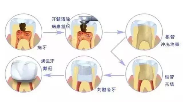 13岁牙齿根管治疗后需要做牙冠吗,根管治疗医生没给我做牙冠