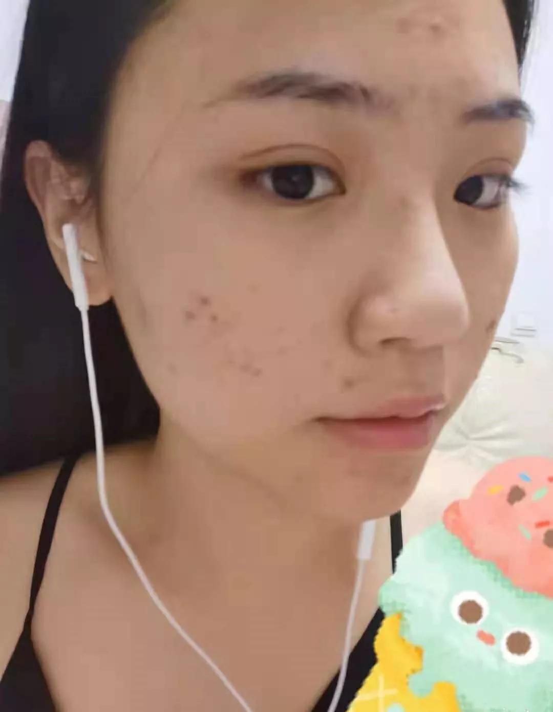 深圳治痘痘皮肤科哪个医院好啊,去皮肤科看痘痘好不好