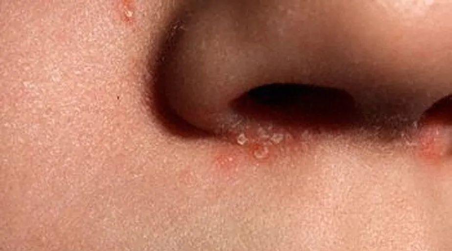 面部敏感发红发烫是什么原因,老年人面部发红是什么原因