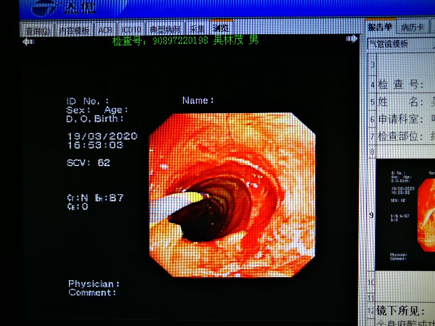 经支气管镜球囊扩张治疗气道狭窄,支气管镜球囊扩张操作视频