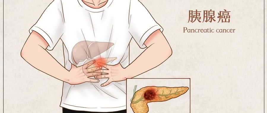 胰腺癌腹泻症状,胰腺癌晚期腹泻是怎么回事