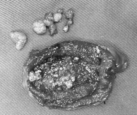 胆囊息肉手术多少钱,发现胆囊息肉怎么办