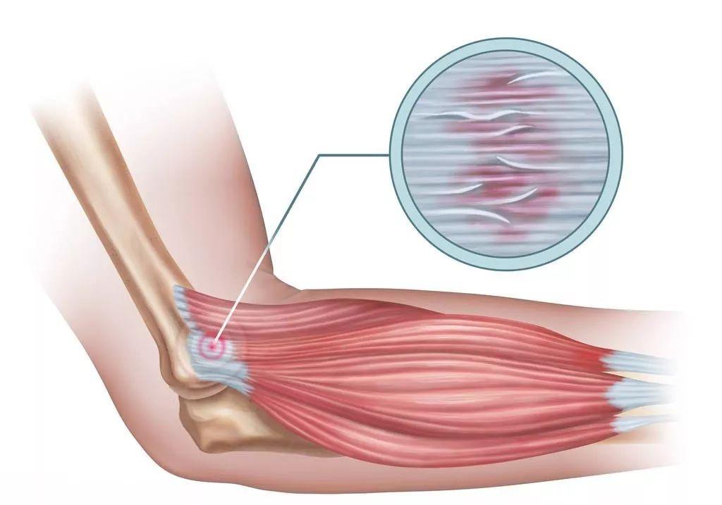 网球肘和高尔夫球肘同时存在,高尔夫球肘和网球肘哪个比较严重