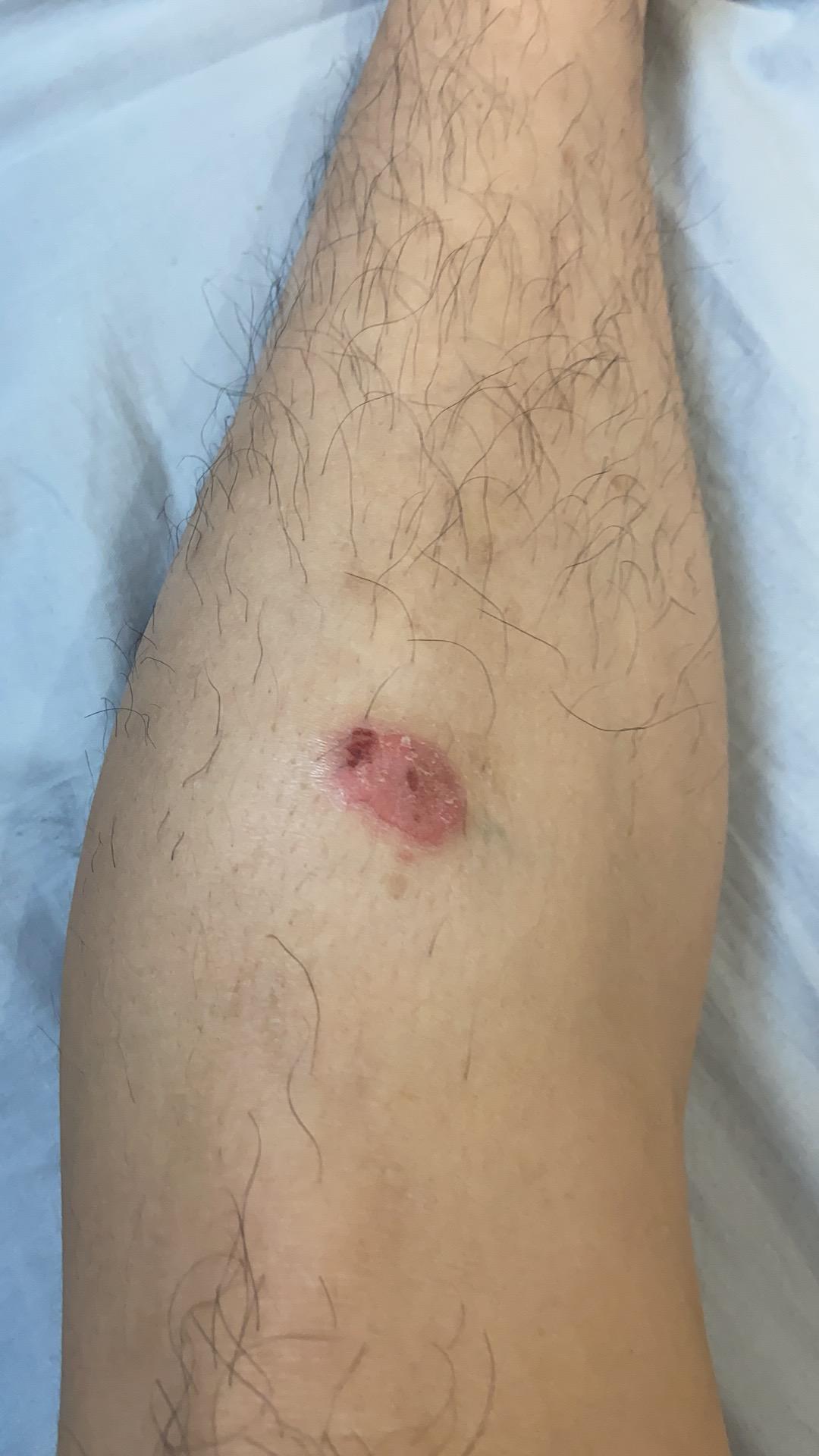 关于银屑病患者在冬季的注意事项,银屑病打生物制剂以后饮食要注意