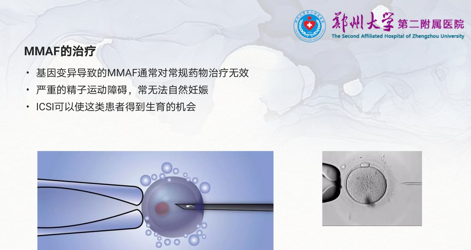 严重弱精症原因,重度少精弱精症可能的原因