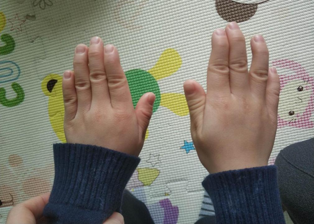 小孩没有咳嗽流鼻涕检查ct是肺炎,咳嗽流鼻涕检查什么