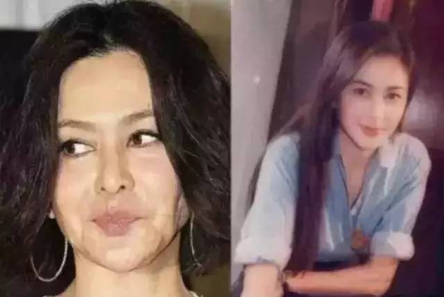 脸颊松弛凹陷怎么能变圆润,脸部凹陷显老怎么办