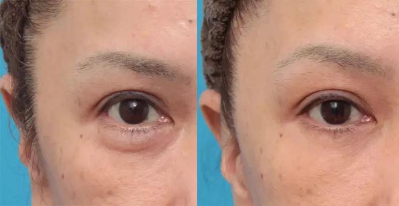 治眼袋三个小妙招快速去眼袋,上眼袋大最简单的去眼袋的方法