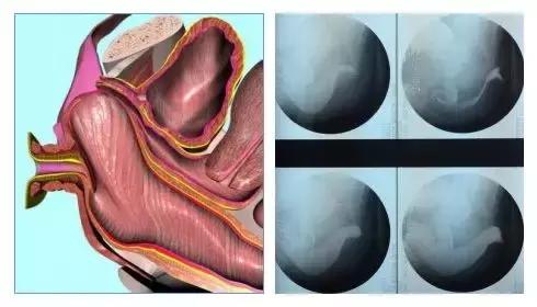 肛肠科：直肠前突是造成便秘的主要因素之一！