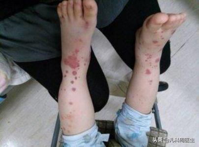 春天孩子皮肤过敏怎么办,儿童春天过敏身上起红疙瘩
