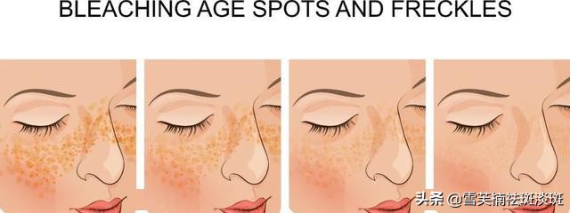 什么办法可以祛斑最快速有效,怎样快速祛斑最快最有效