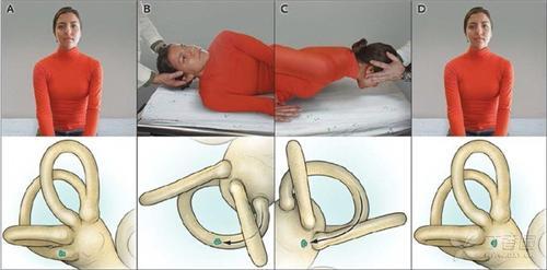 耳石症眩晕属于神经的问题吗,耳石症挂耳鼻喉科还是眩晕科