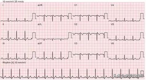 人工智能技术在电学中的应用案例,人工智能在心电图的应用