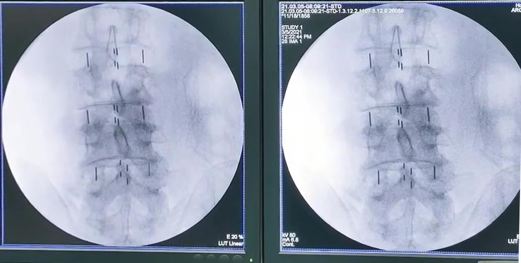 腰椎退变侧弯是什么意思,年轻人腰椎退行性改变是怎么回事