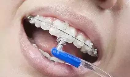 矫正牙齿是如何戴牙套的,矫正牙齿戴牙套需要注意事项