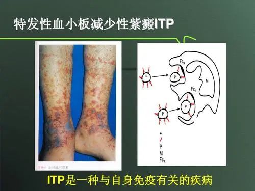 归脾汤治疗免疫性血小板减少,益气活血汤血小板减少症