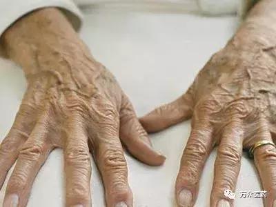 怎样预防老年斑及去除老年斑,怎么能去掉老年斑和预防老年斑
