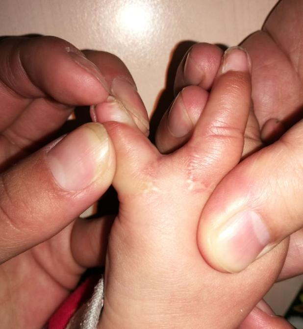 并指畸形免植皮案例,并指畸形