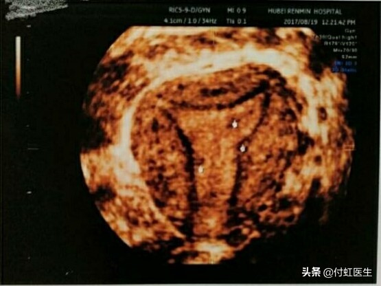 无痛人流不全再清宫危害大吗,无痛人流后偶尔碰凉水有危害吗