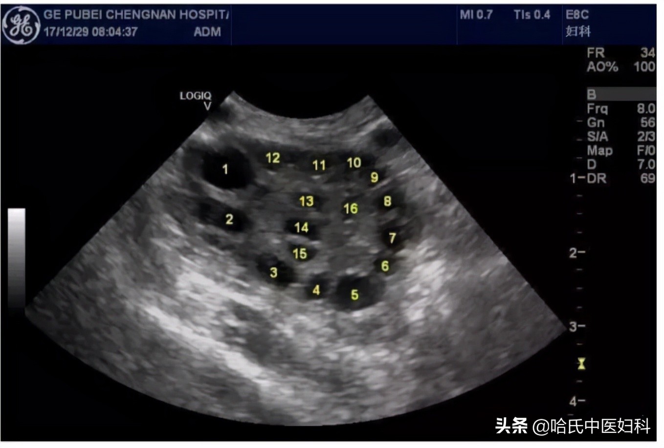 多囊卵巢综合症如何快速怀孕,多囊卵巢综合征怀孕了容易流产吗
