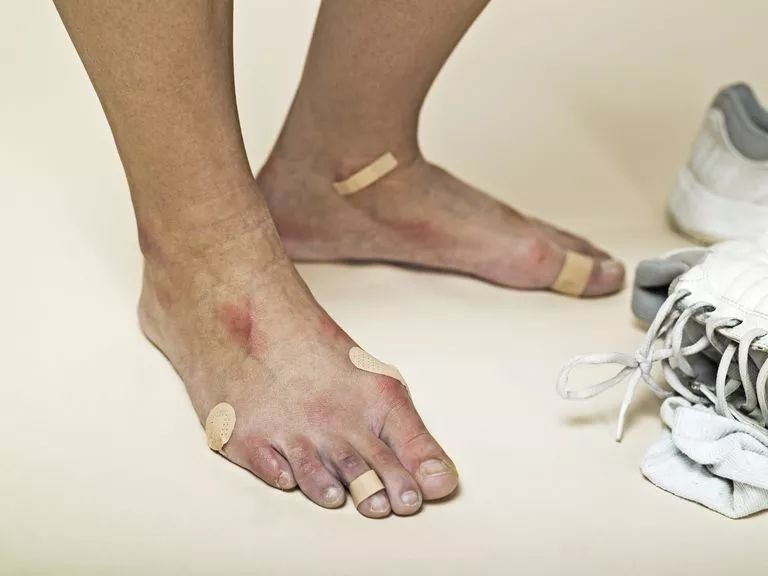 长时间运动起水泡？预防水泡，这个神器适合你