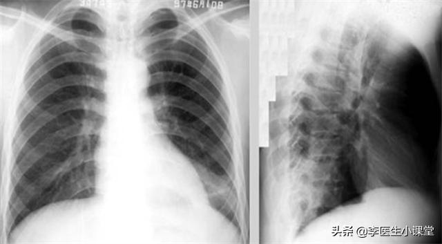 阿莫西林别乱吃只对四种病有效,阿莫西林到底适用哪四大疾病呢