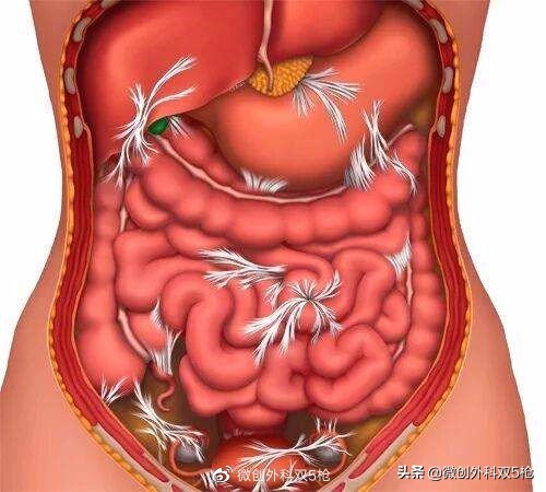 阑尾炎会引起左腹痛吗,阑尾炎腹痛的典型表现