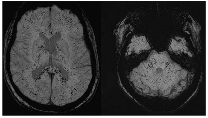 头疼做磁共振脑小血管有点出血,核磁共振说脑血管出血