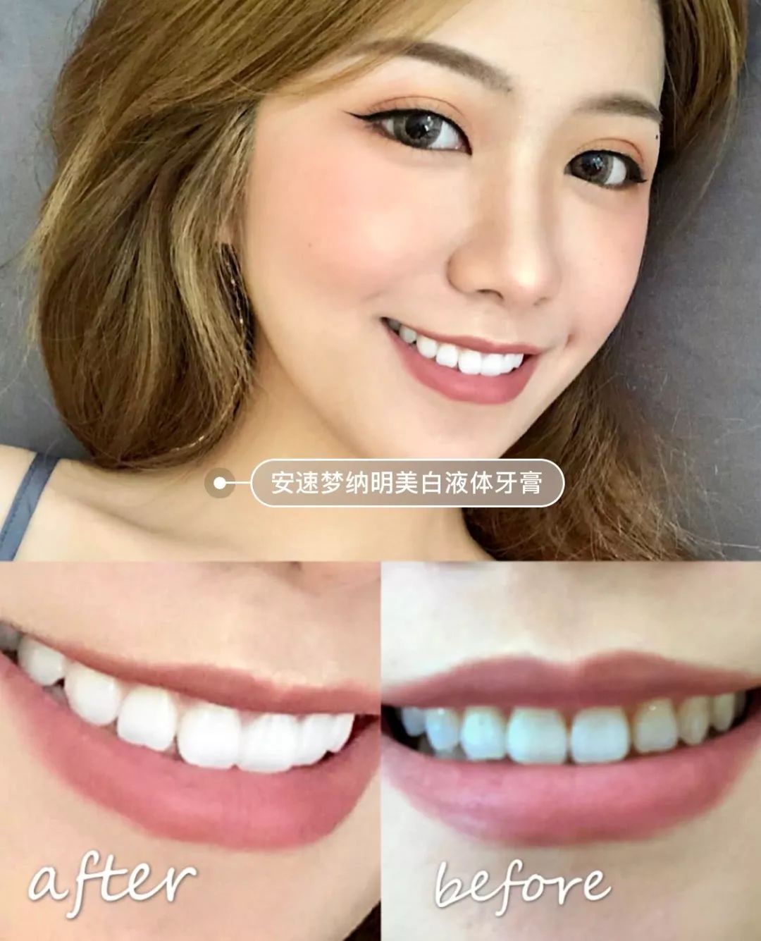 刘涛是全口瓷牙,演员刘涛的一口烤瓷牙多少钱