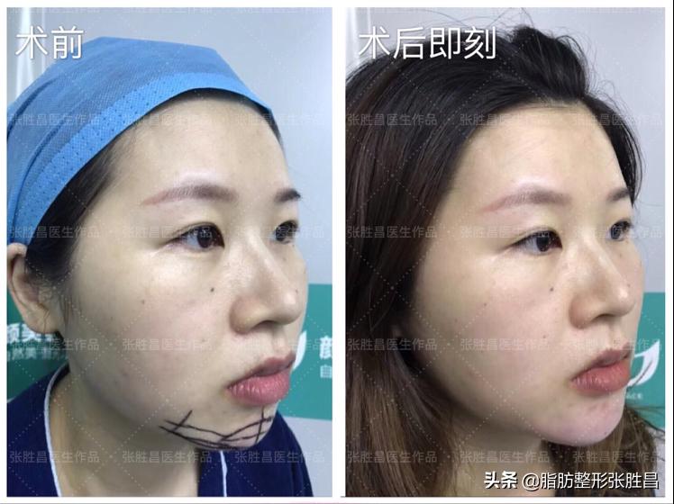 后缩的下巴打玻尿酸效果会好吗,下巴后缩打玻尿酸有效果吗