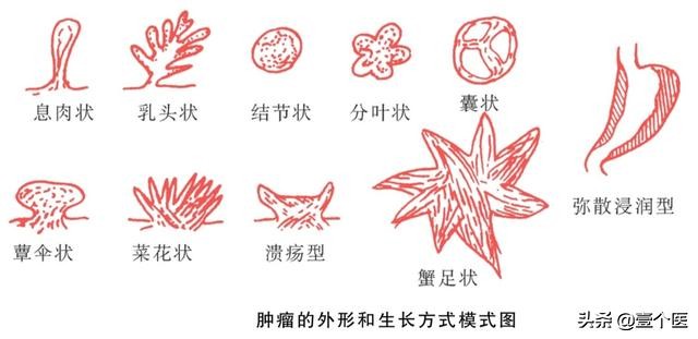 癌前病变非典型增生解释,病理出现原位癌和浸润性癌