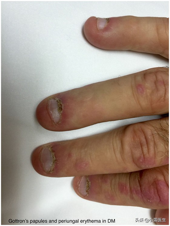 肩肌炎严重吗,从肩到后背疼痛是什么原因