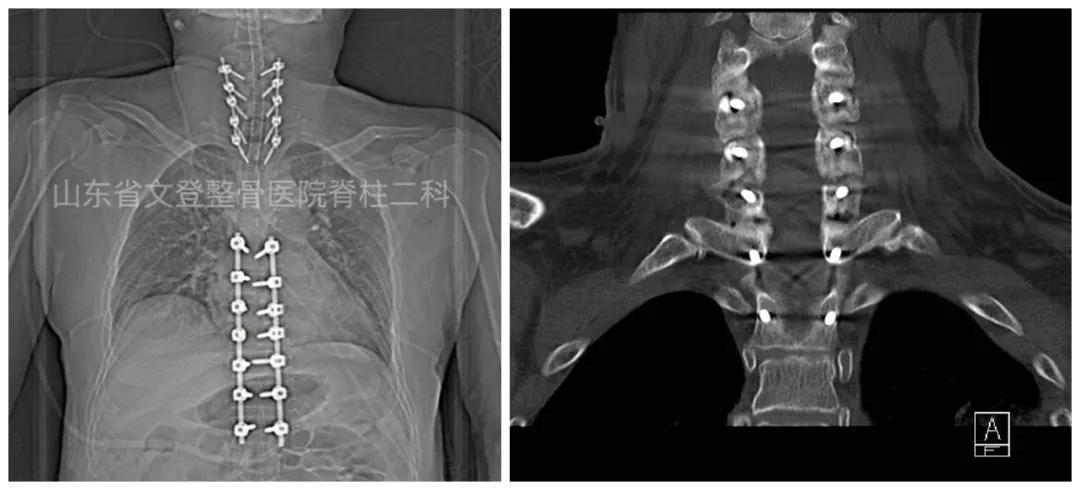 文登整骨医院治疗截瘫,山东文登整骨医院治疗怎么样
