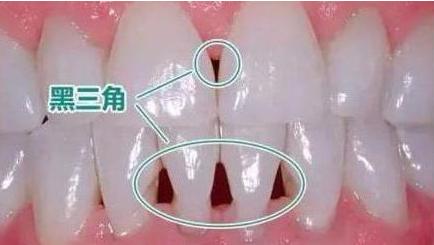 为什么牙齿黑三角不可逆,黑三角是不可逆的吗