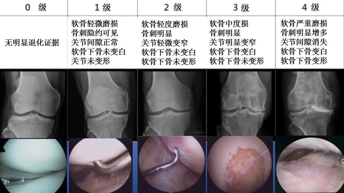 膝关节骨性关节炎症状及治疗,膝关节骨性关节炎诊疗指南下载