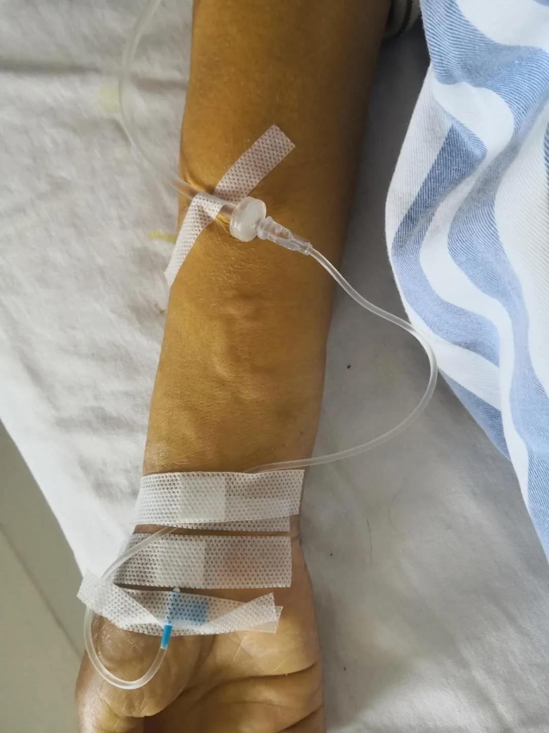 病人输液胳膊肿胀咋了,胳膊有点像输液的那种疼痛