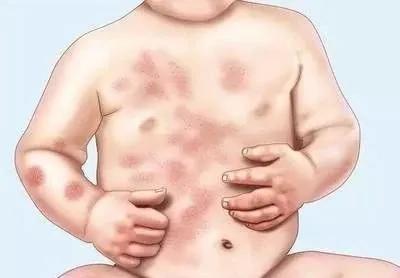 宝宝脸上长湿疹妈妈需要忌口吗,湿疹好了还用忌口吗