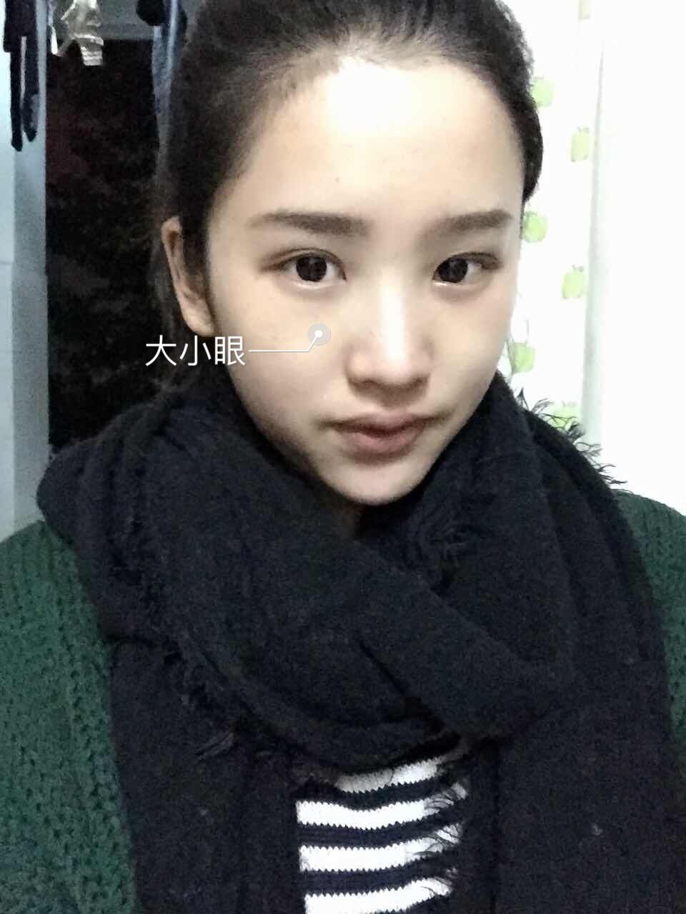 做了埋线双眼皮后悔了,做完双眼皮后悔的多吗