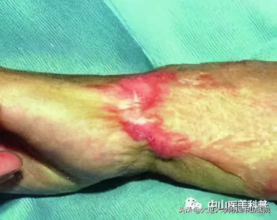 疤痕祛除咨询,一些疤痕的治疗效果图