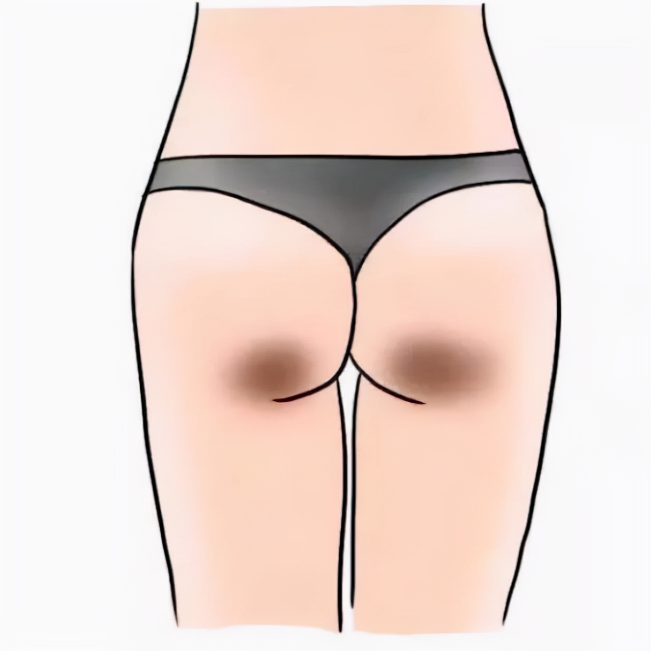 屁股上坐出来的黑色印子怎么消除,长期坐着屁股两边有黑印子怎么办