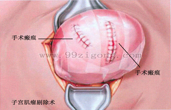 子宫肌瘤手术后一般几年再复发,子宫肌瘤手术后复发中医治疗