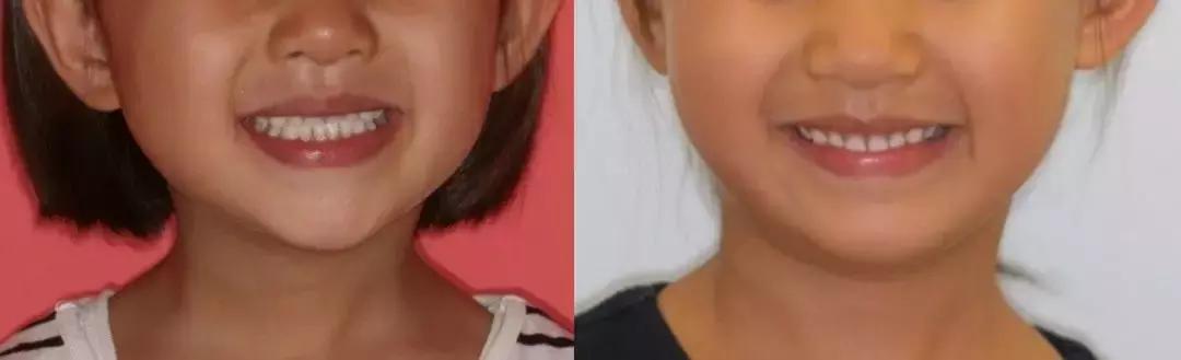 动画模拟牙齿矫正前后会变美,做了矫正牙齿会反弹吗