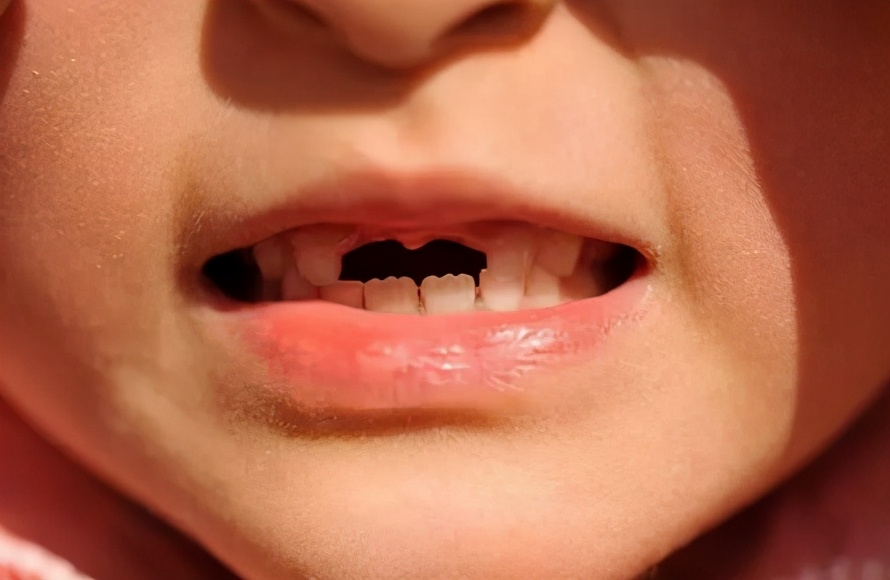 乳牙脱落后的最佳处理方法,小孩的第一颗乳牙脱落要怎么处理