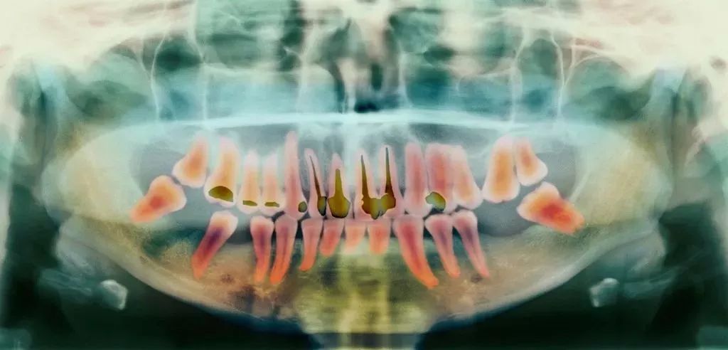 牙蛀了必须根管吗,牙蛀到什么程度需要补牙