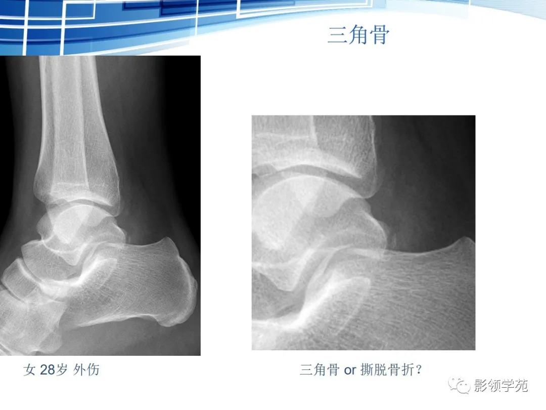 桡骨远端骨折引起尺骨变异,撕脱骨折一个月无明显骨痂形成